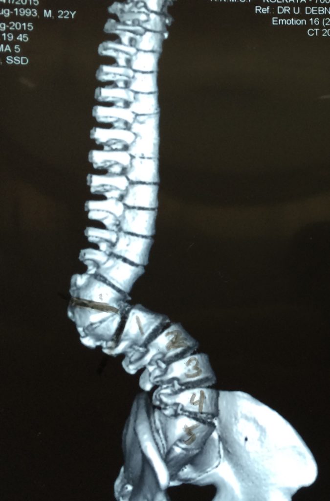 congenital spinal deformity icd 10